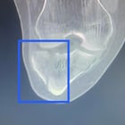 I broke my ankle before reaching 22 mile