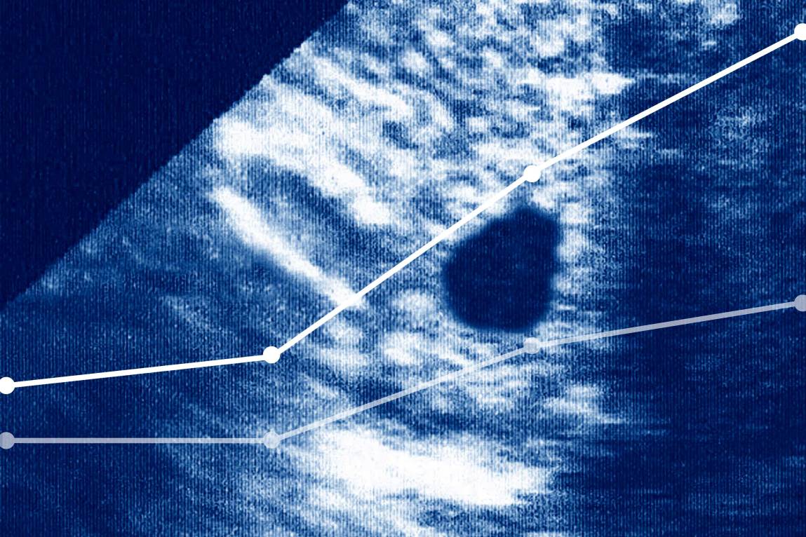 Ectopic pregnancy seen on a pelvic ultrasound, overlaid with a simplified version of the line chart depicting death rates from ectopic pregnancies.