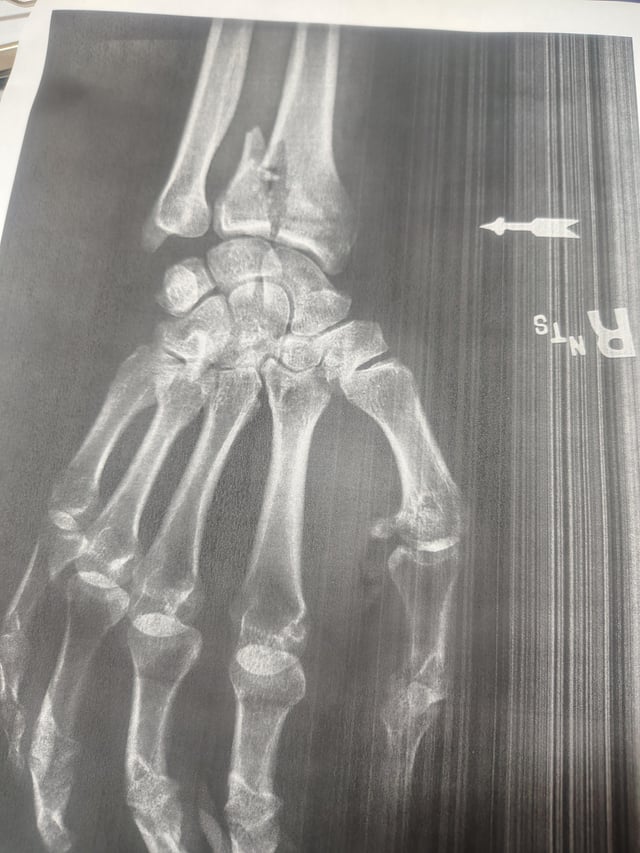 Wear your wrist guards fam!