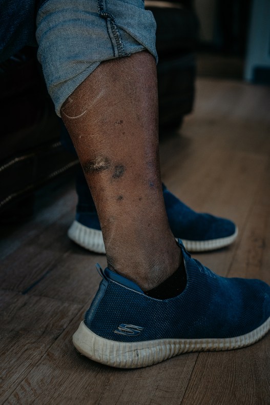 A man’s leg with his pant leg rolled up. Above his ankle, there are scars.